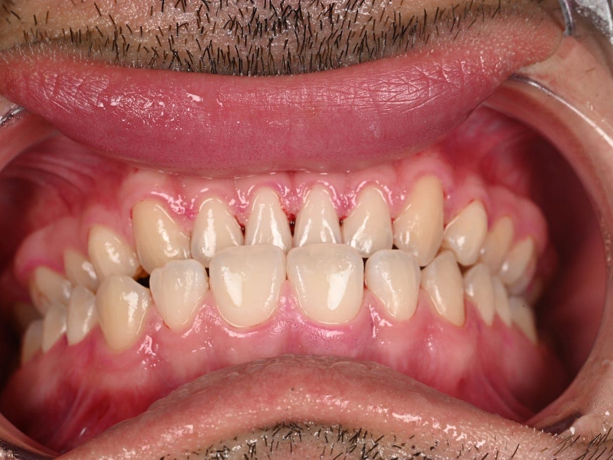 Clean teeth after Airflow GBT prophylaxis