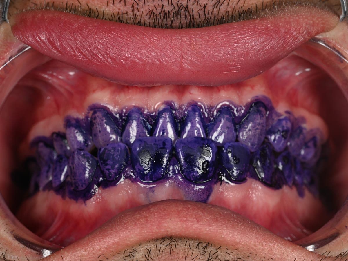 Dental biofilm revealed with disclosing dye before Airflow