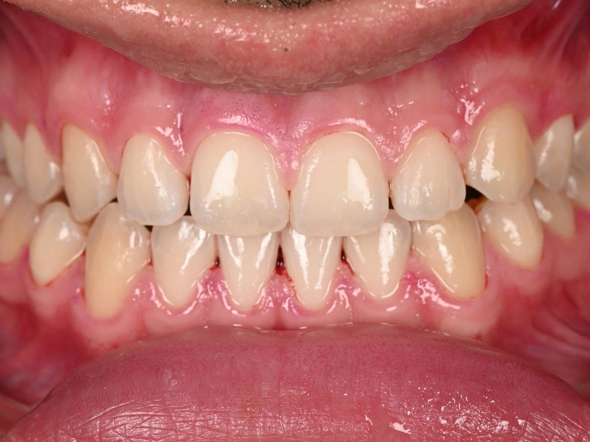 Dientes limpios tras profilaxis Airflow GBT