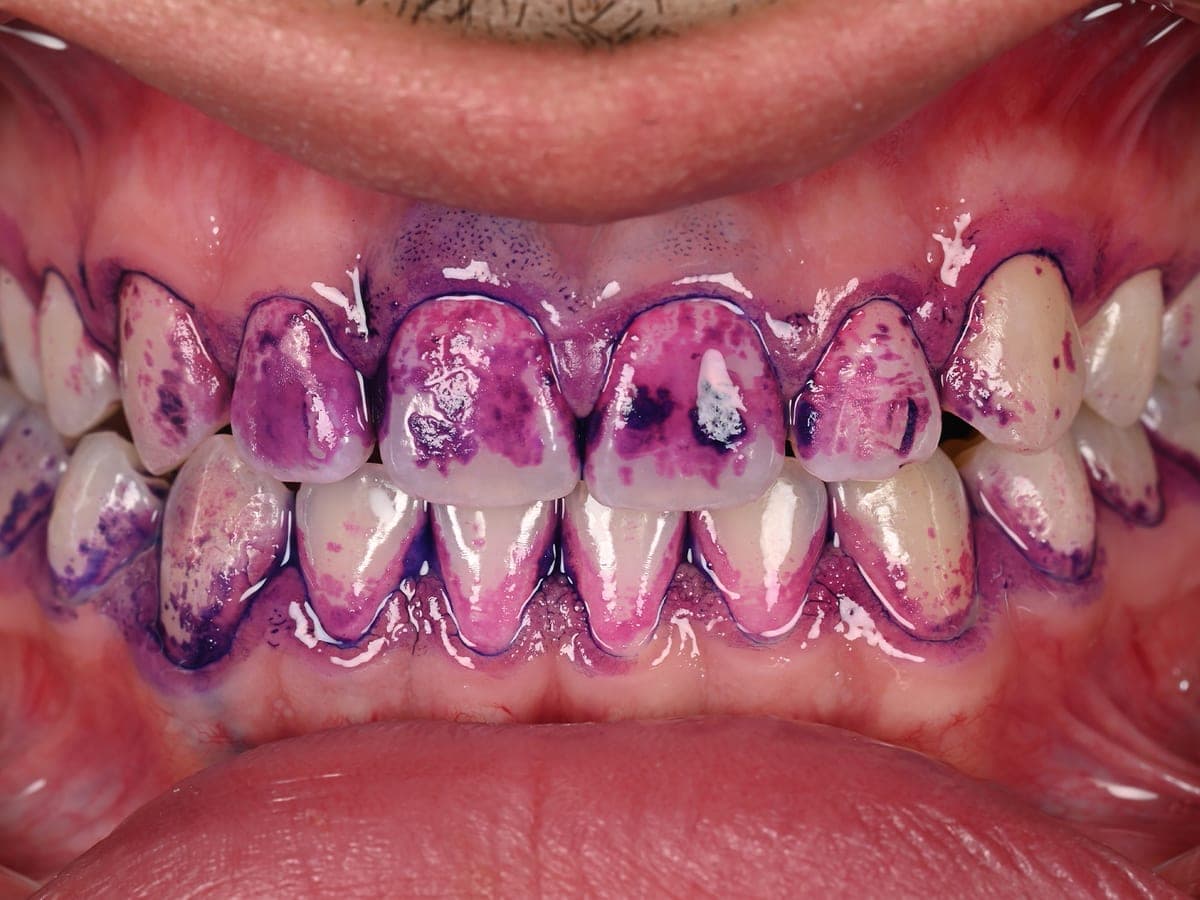 Biofilm dental revelado con colorante antes de Airflow