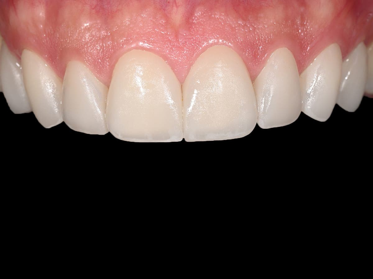 Sonrisa renovada con carillas de porcelana