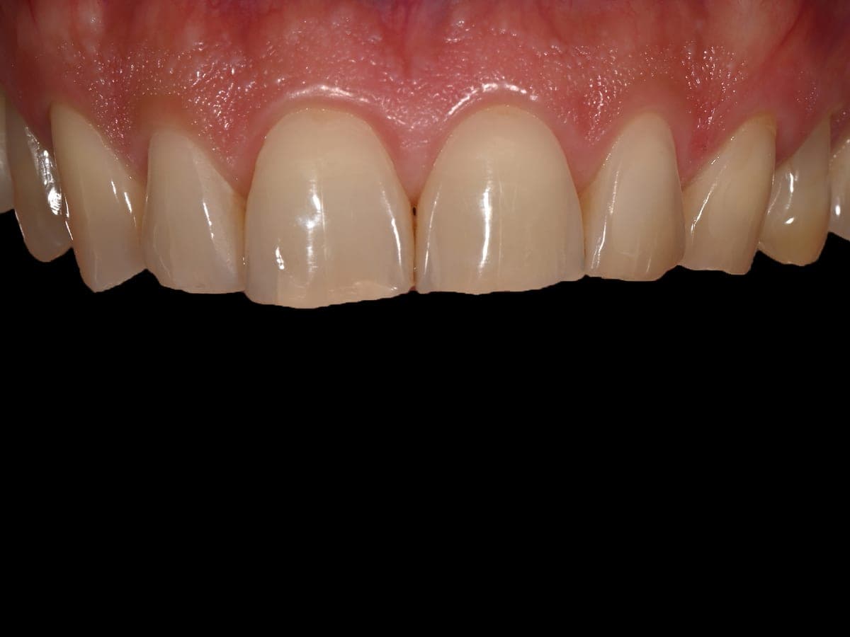 Dientes desgastados antes de carillas de porcelana