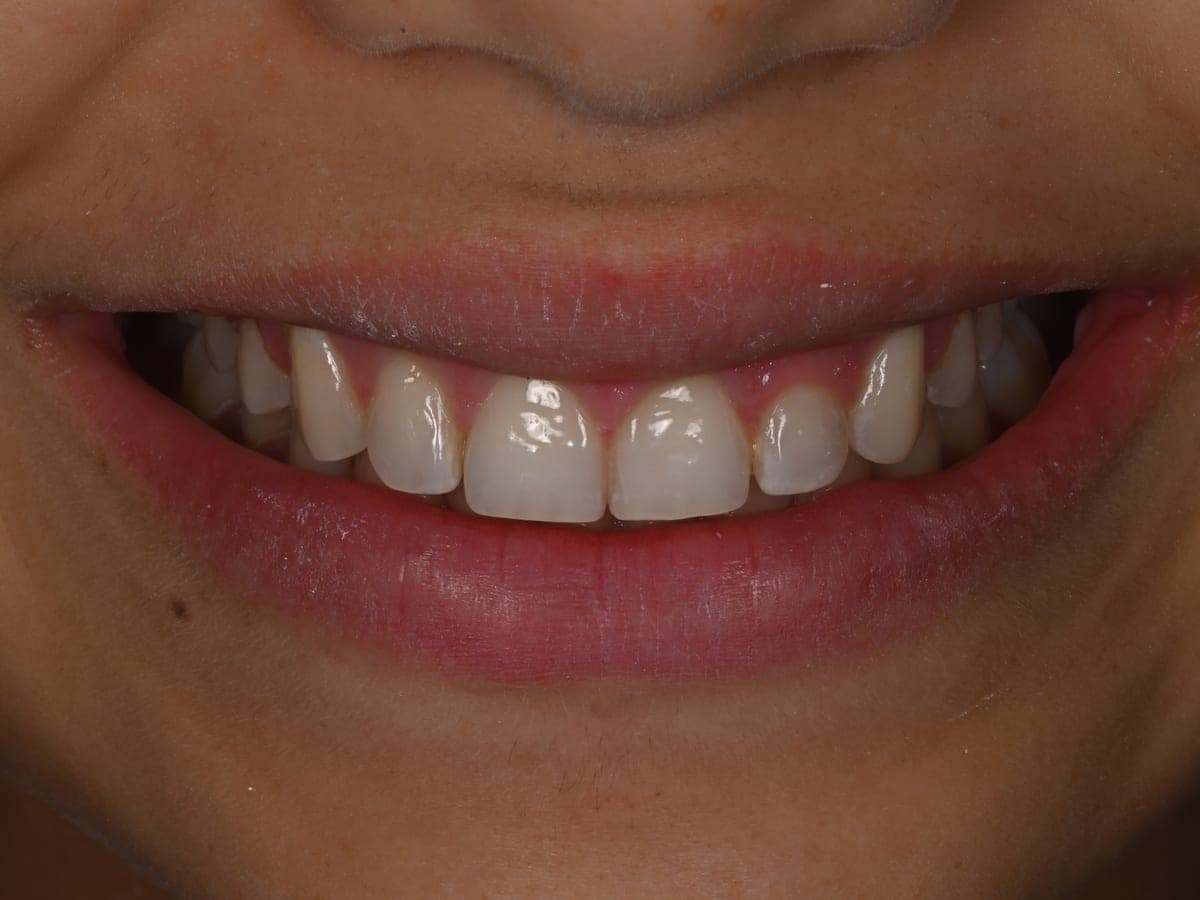 Sonrisa gingival antes del contorneado de encías