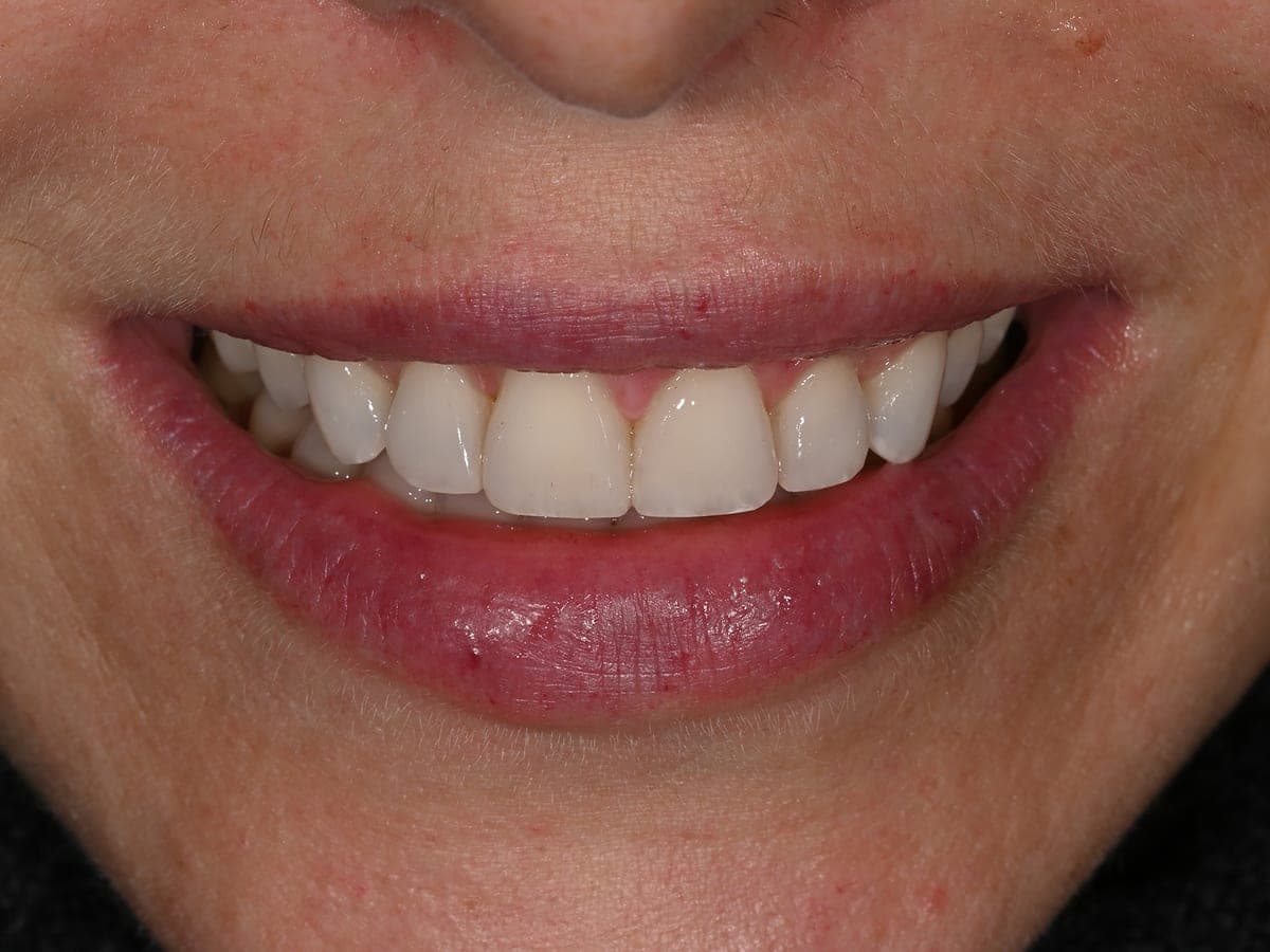 Sonrisa renovada con encías contorneadas y resina
