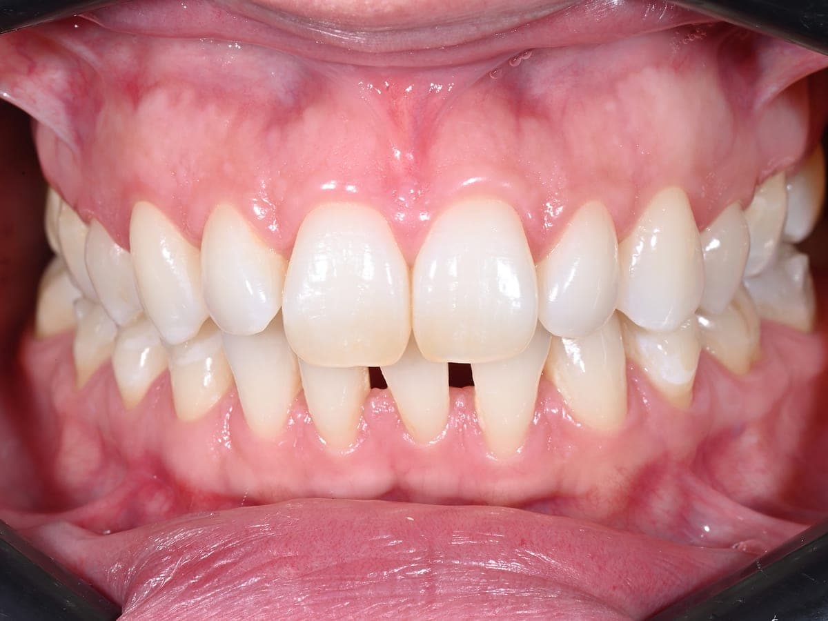 Triángulos negros entre los dientes antes de ortodoncia invisible