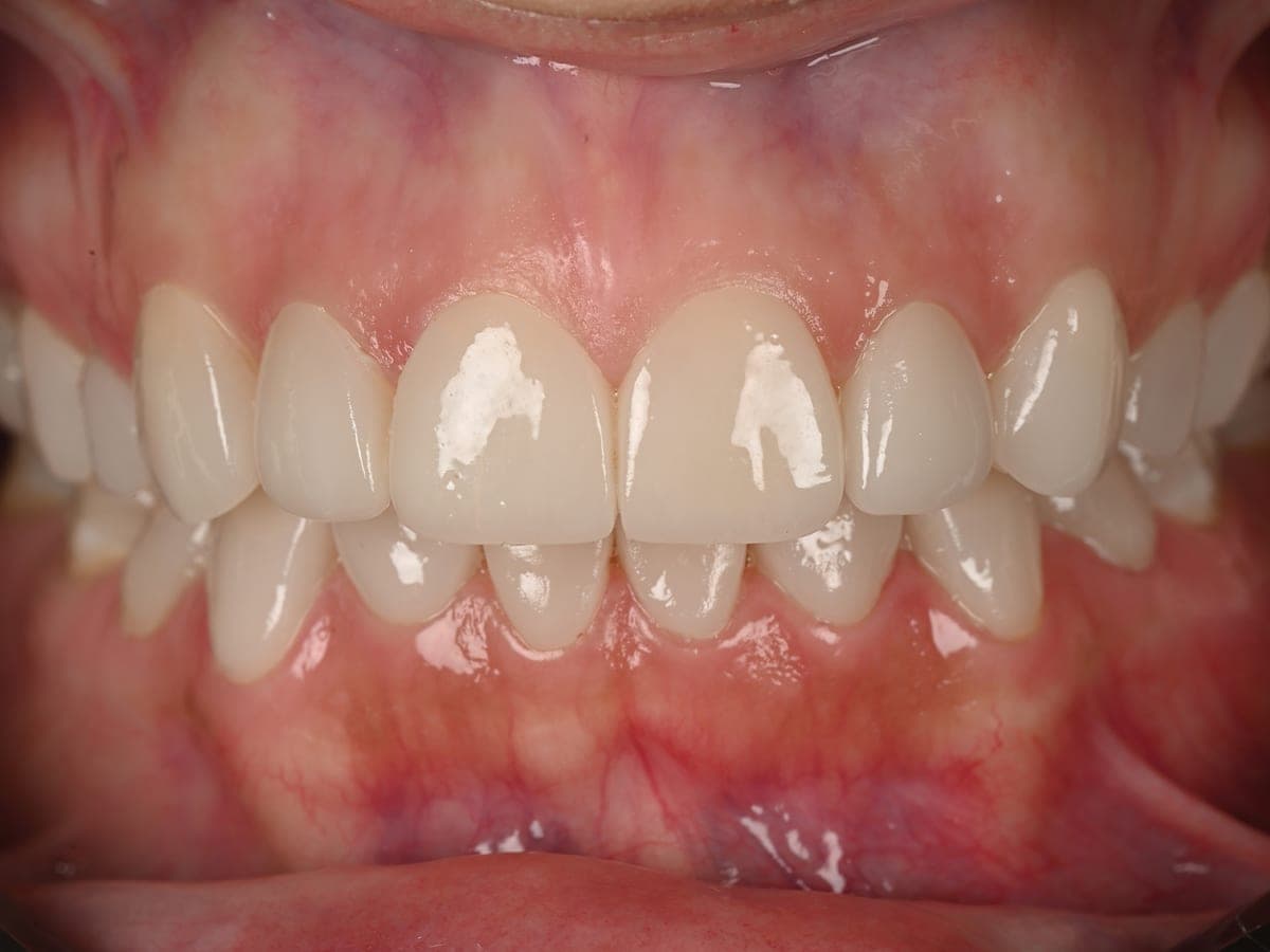 Dentición reconstruida tras rehabilitación oral completa