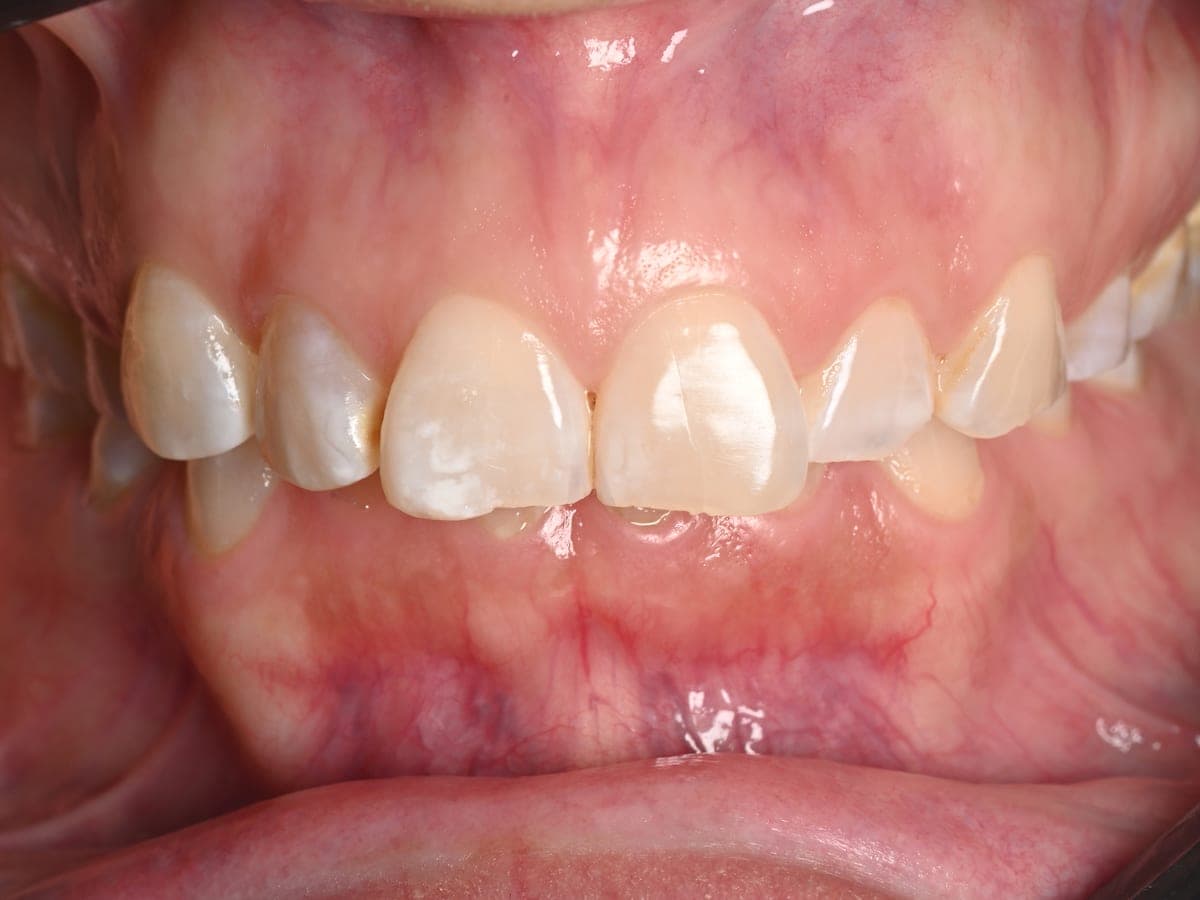 Dentición con erosión severa antes de la rehabilitación oral